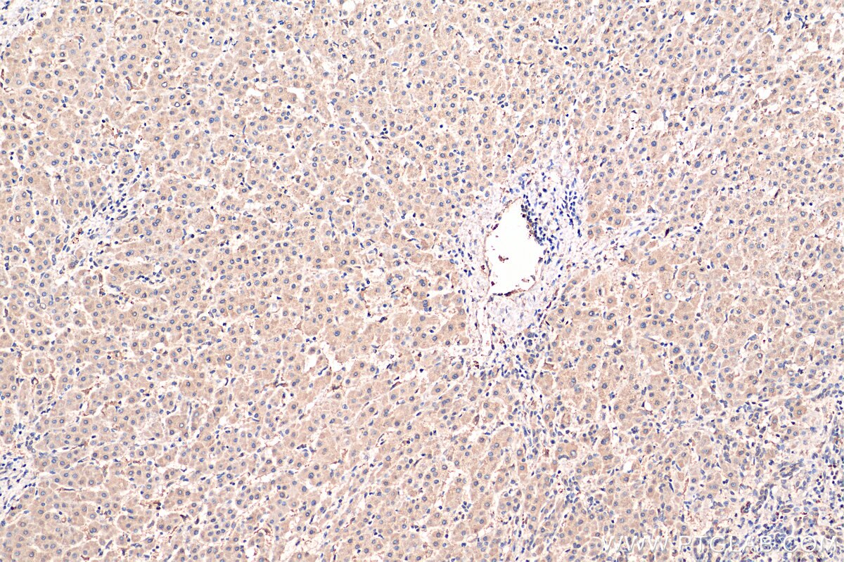 IHC staining of human liver cancer using 66342-1-Ig