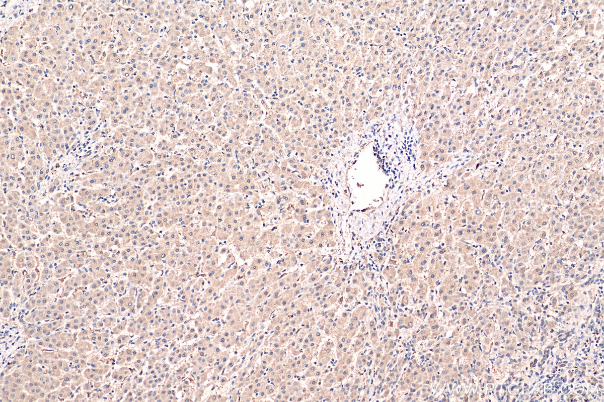 Immunohistochemistry (IHC) staining of human liver cancer tissue using PLOD2 Monoclonal antibody (66342-1-Ig)