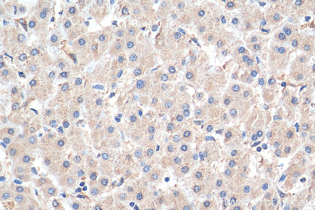 Immunohistochemistry (IHC) staining of human liver cancer tissue using PLOD2 Monoclonal antibody (66342-1-Ig)