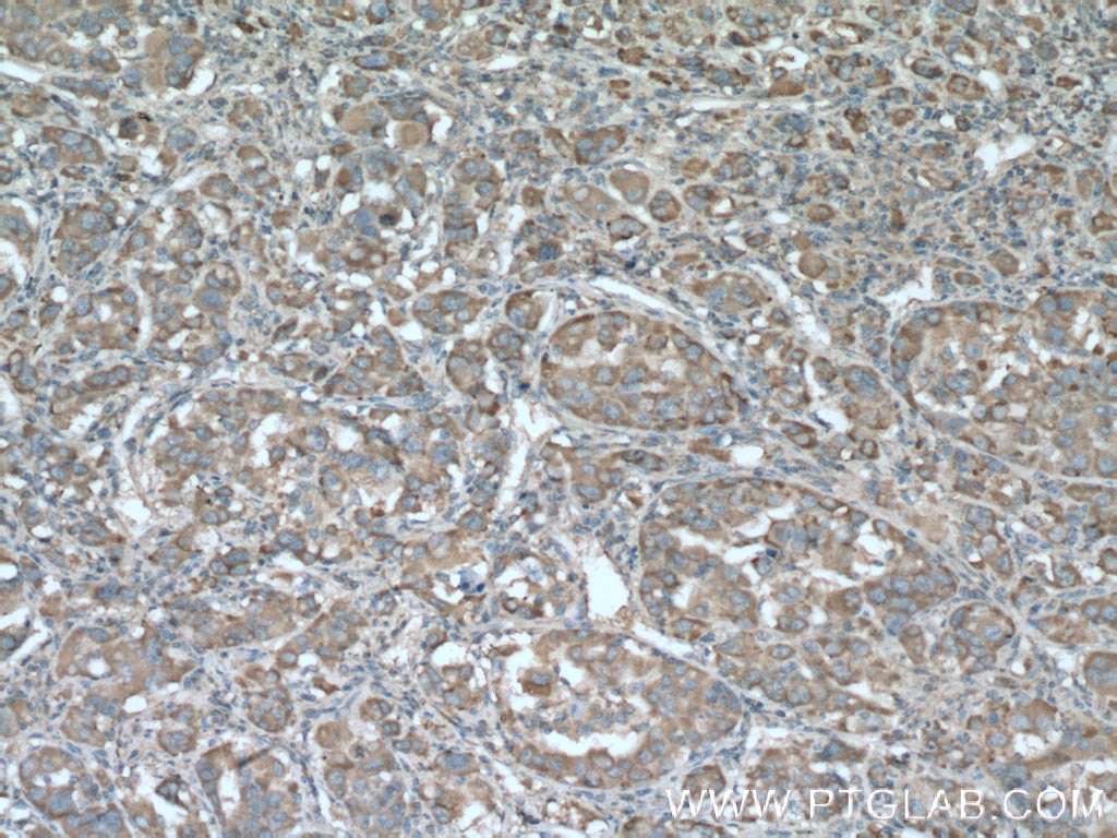 Immunohistochemistry (IHC) staining of human liver cancer tissue using PLOD2 Monoclonal antibody (66342-1-Ig)