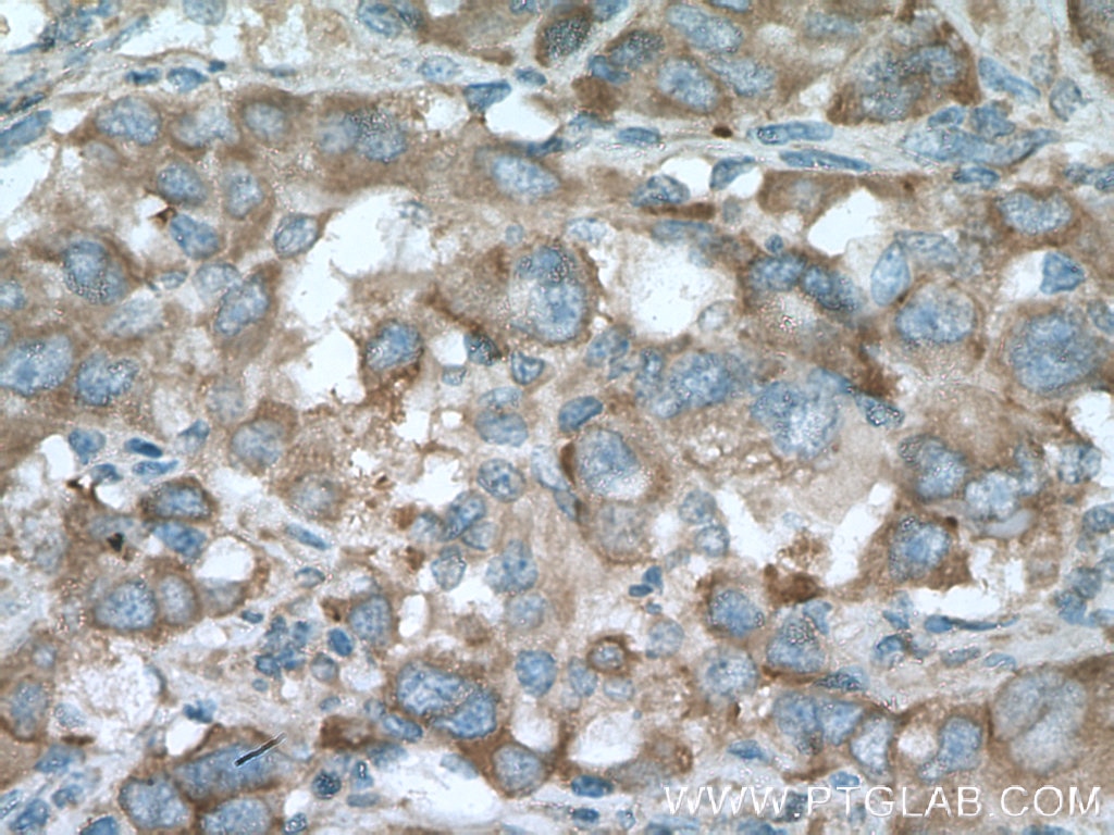 Immunohistochemistry (IHC) staining of human liver cancer tissue using PLOD2 Monoclonal antibody (66342-1-Ig)