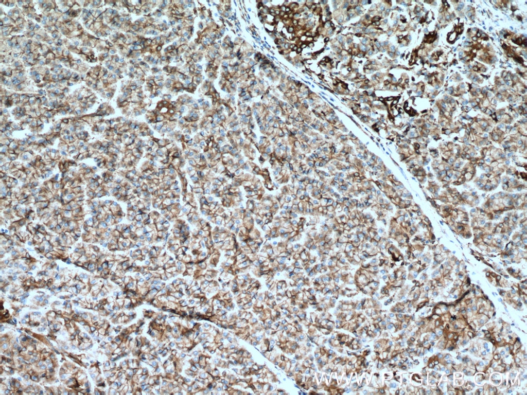 Immunohistochemistry (IHC) staining of human pancreas cancer tissue using PLOD3 Polyclonal antibody (11027-1-AP)