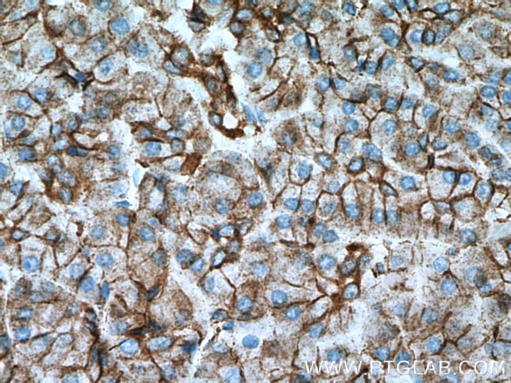 IHC staining of human pancreas cancer using 11027-1-AP