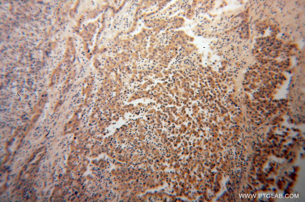 Immunohistochemistry (IHC) staining of human pancreas cancer tissue using PLOD3 Monoclonal antibody (60058-1-Ig)