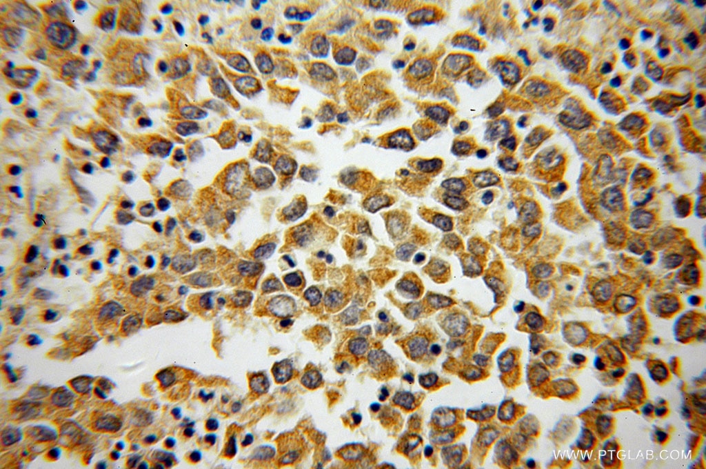 Immunohistochemistry (IHC) staining of human pancreas cancer tissue using PLOD3 Monoclonal antibody (60058-1-Ig)