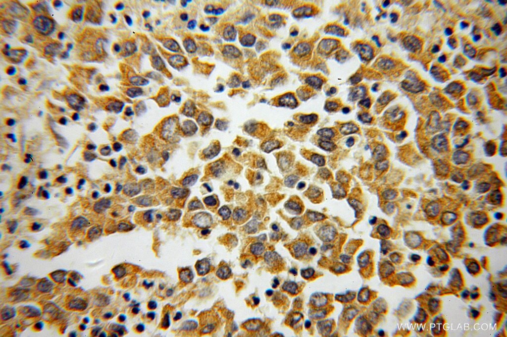 IHC staining of human pancreas cancer using 60058-1-Ig