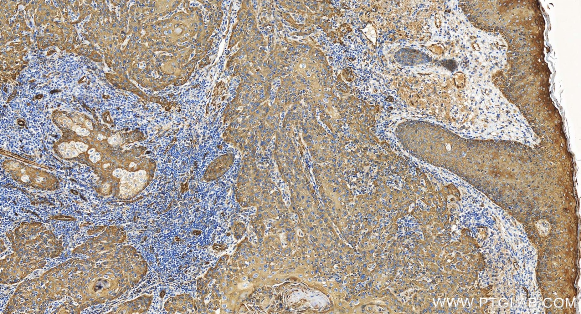 Immunohistochemistry (IHC) staining of human skin cancer tissue using PLS3 Recombinant antibody (86323-1-RR)