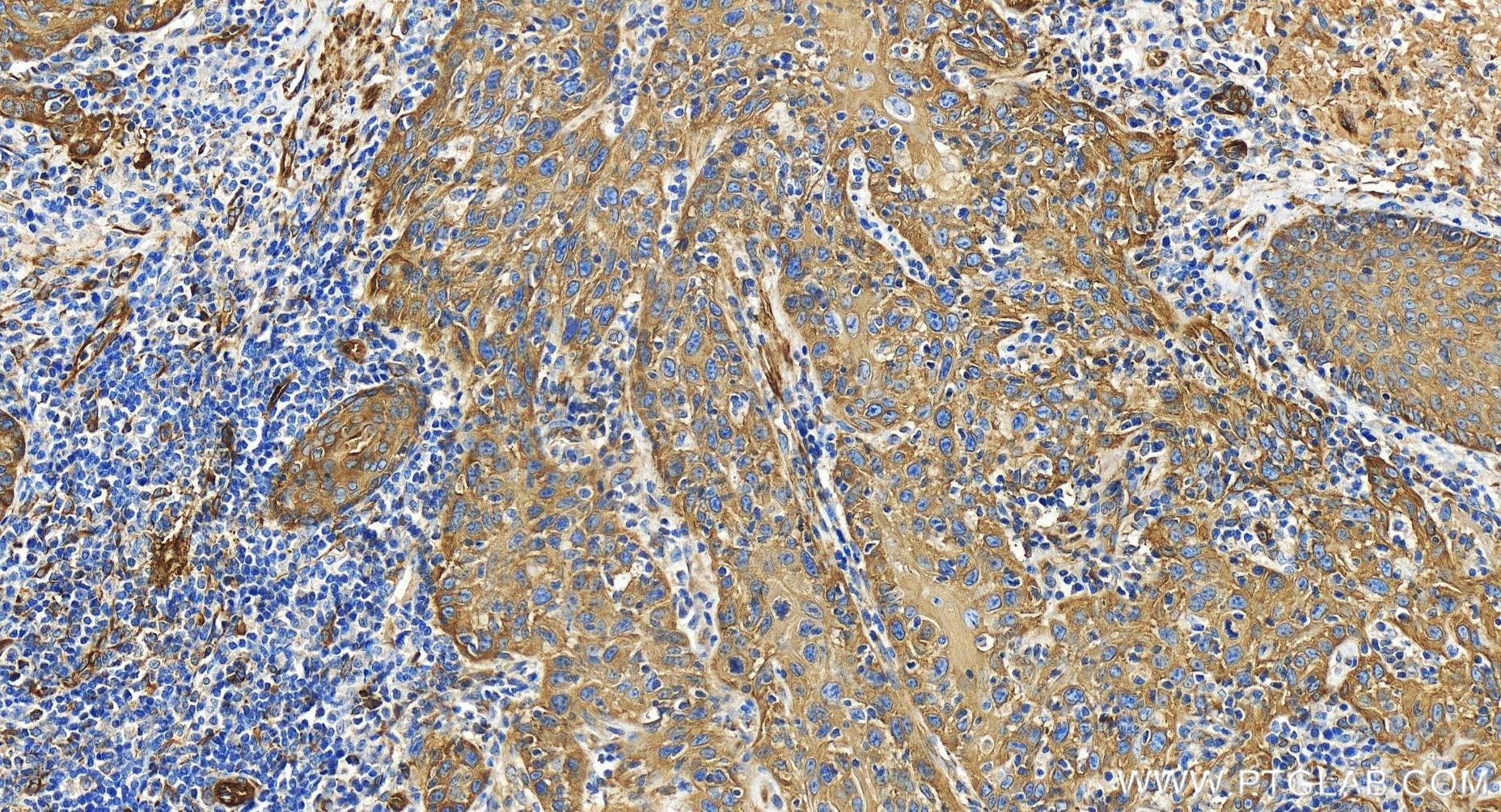 Immunohistochemistry (IHC) staining of human skin cancer tissue using PLS3 Recombinant antibody (86323-1-RR)
