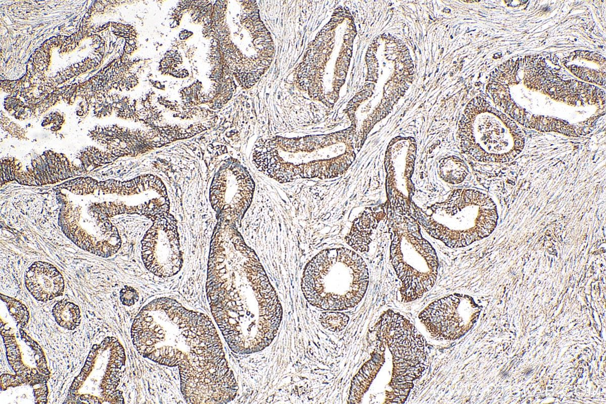 Immunohistochemistry (IHC) staining of human pancreas cancer tissue using PLSCR1 Polyclonal antibody (11582-1-AP)