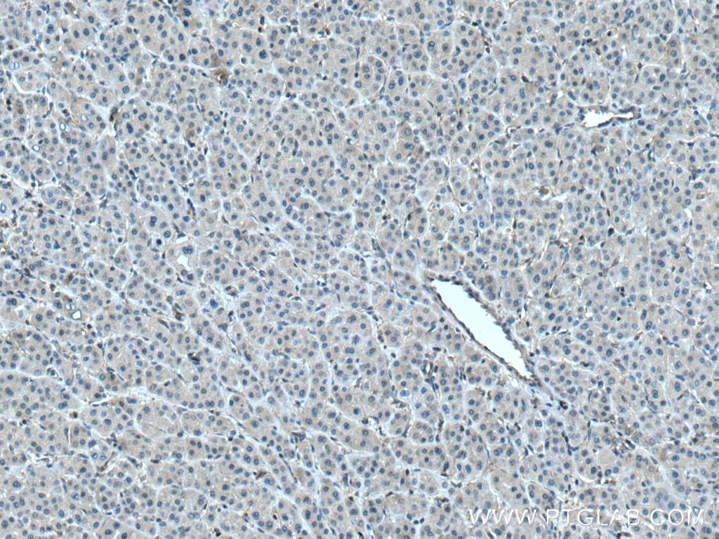 Immunohistochemistry (IHC) staining of human liver cancer tissue using PLSCR3 Polyclonal antibody (28028-1-AP)
