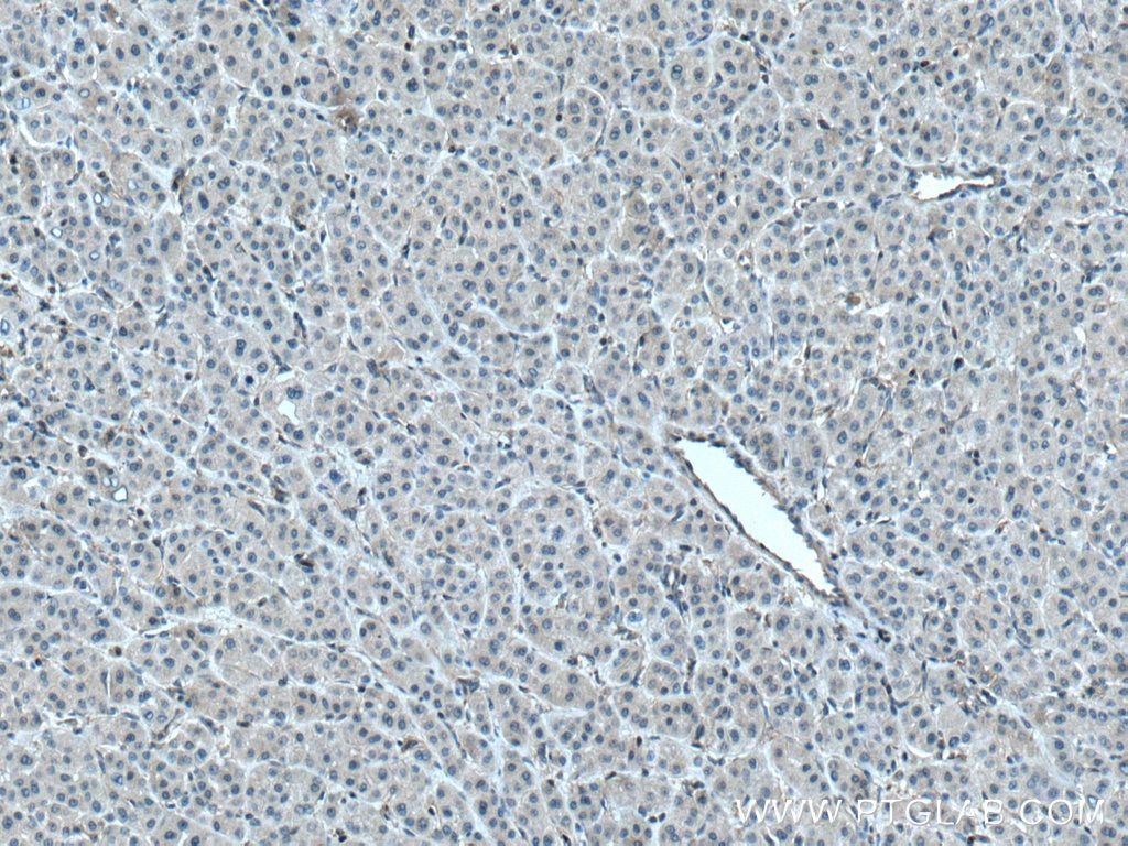 Immunohistochemistry (IHC) staining of human liver cancer tissue using PLSCR3 Polyclonal antibody (28028-1-AP)