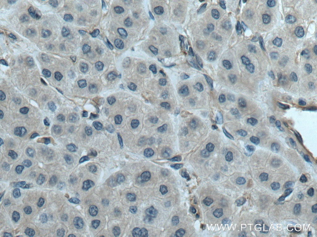 Immunohistochemistry (IHC) staining of human liver cancer tissue using PLSCR3 Polyclonal antibody (28028-1-AP)