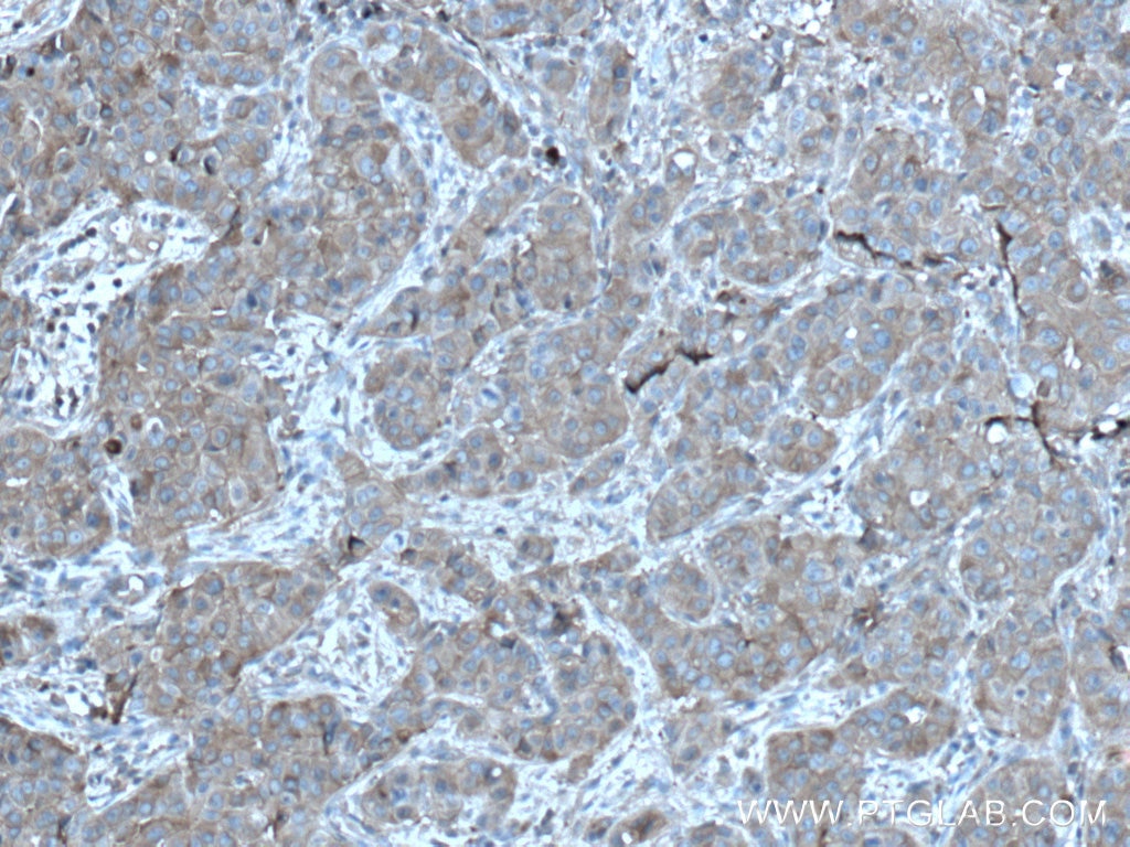Immunohistochemistry (IHC) staining of human breast cancer tissue using PLSCR3 Polyclonal antibody (28028-1-AP)