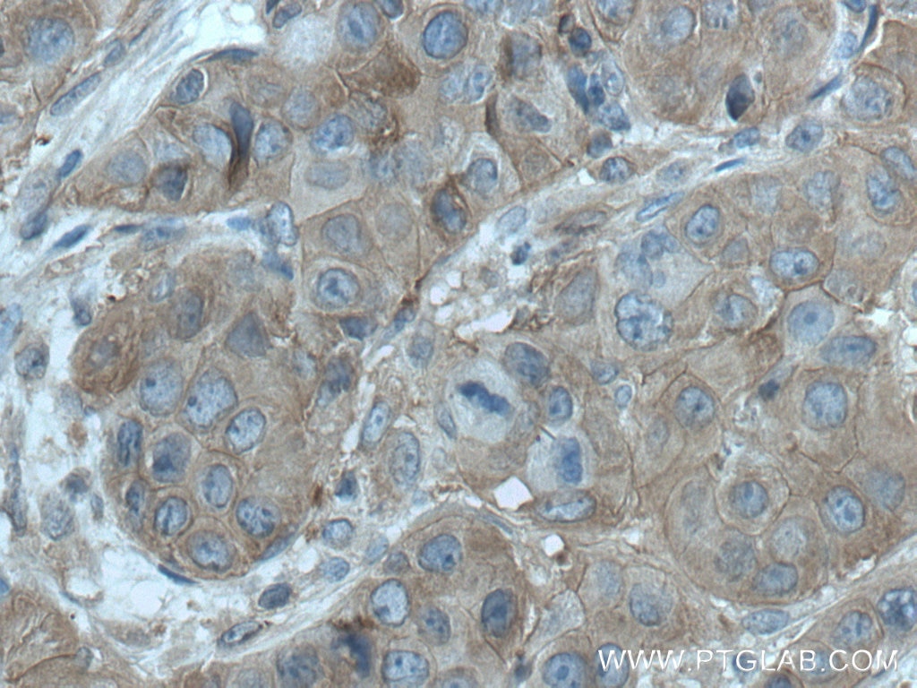 Immunohistochemistry (IHC) staining of human breast cancer tissue using PLSCR3 Polyclonal antibody (28028-1-AP)