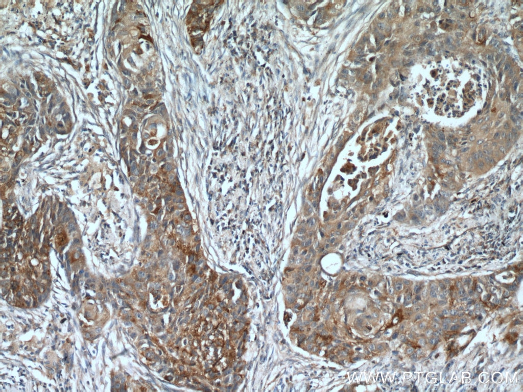 Immunohistochemistry (IHC) staining of human lung cancer tissue using PLUNC Polyclonal antibody (10413-1-AP)