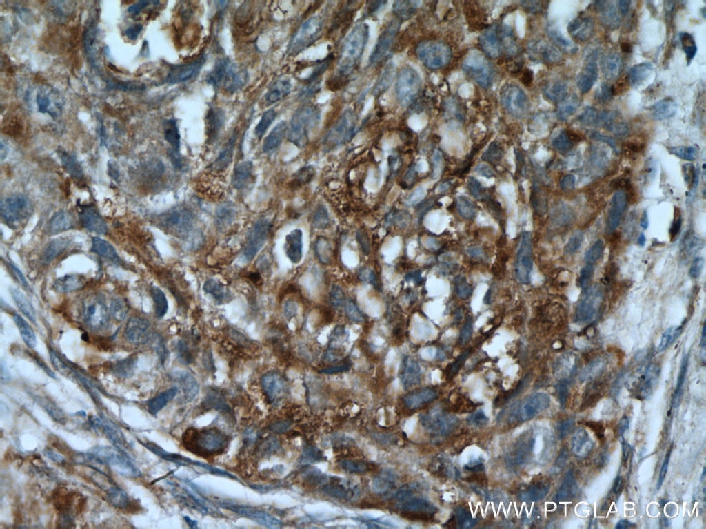Immunohistochemistry (IHC) staining of human lung cancer tissue using PLUNC Polyclonal antibody (10413-1-AP)