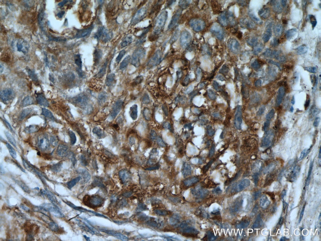 IHC staining of human lung cancer using 10413-1-AP