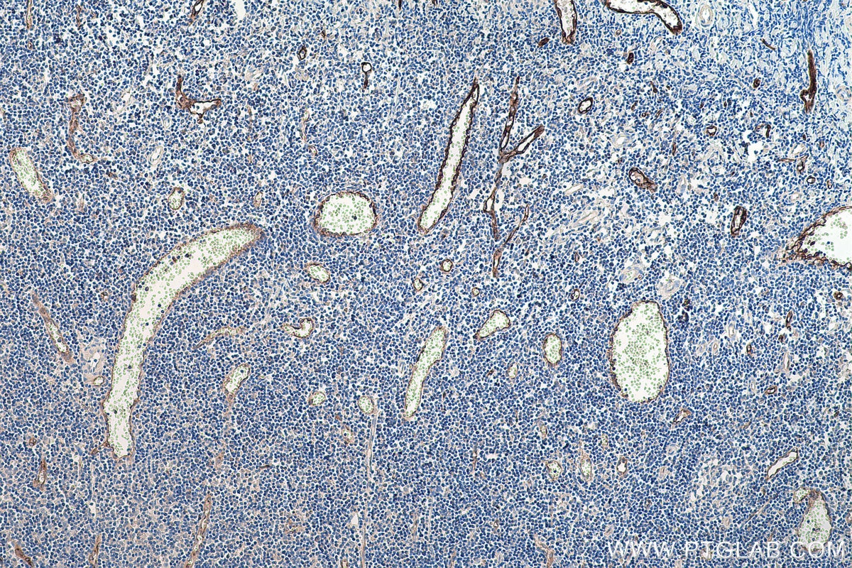 Immunohistochemistry (IHC) staining of human tonsillitis tissue using PLVAP Monoclonal antibody (67158-1-Ig)