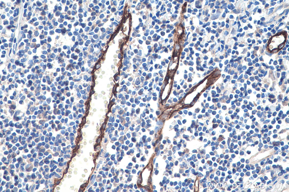 Immunohistochemistry (IHC) staining of human tonsillitis tissue using PLVAP Monoclonal antibody (67158-1-Ig)