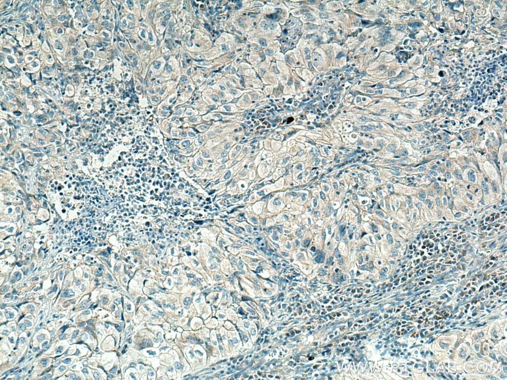 Immunohistochemistry (IHC) staining of human lung cancer tissue using PLXDC2 Polyclonal antibody (12285-1-AP)