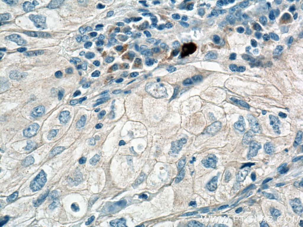 Immunohistochemistry (IHC) staining of human lung cancer tissue using PLXDC2 Polyclonal antibody (12285-1-AP)