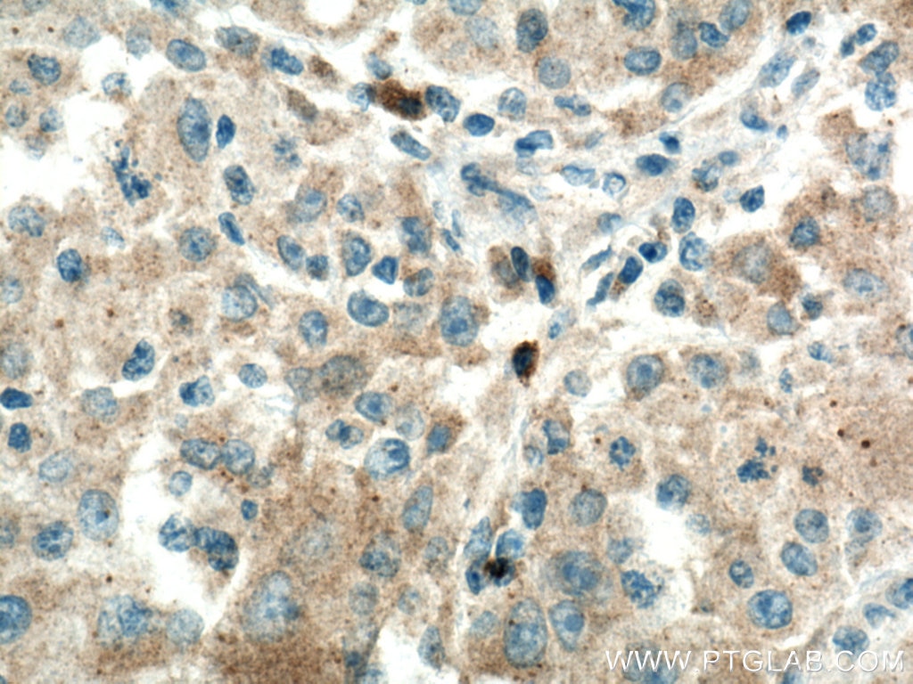 Immunohistochemistry (IHC) staining of human liver cancer tissue using PLXDC2 Polyclonal antibody (12285-1-AP)