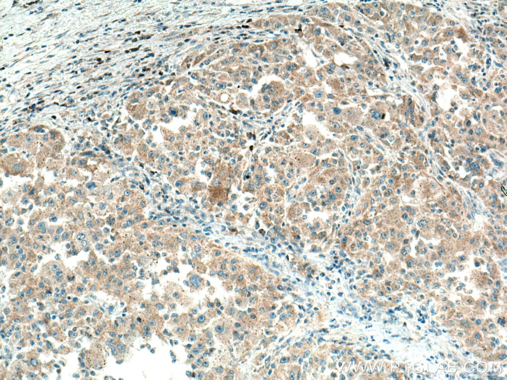 Immunohistochemistry (IHC) staining of human liver cancer tissue using PLXDC2 Polyclonal antibody (12285-1-AP)