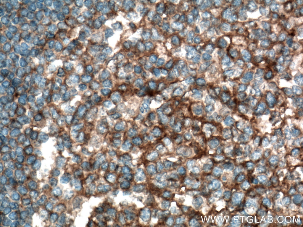 Immunohistochemistry (IHC) staining of human tonsillitis tissue using Plexin B2 Polyclonal antibody (10602-1-AP)