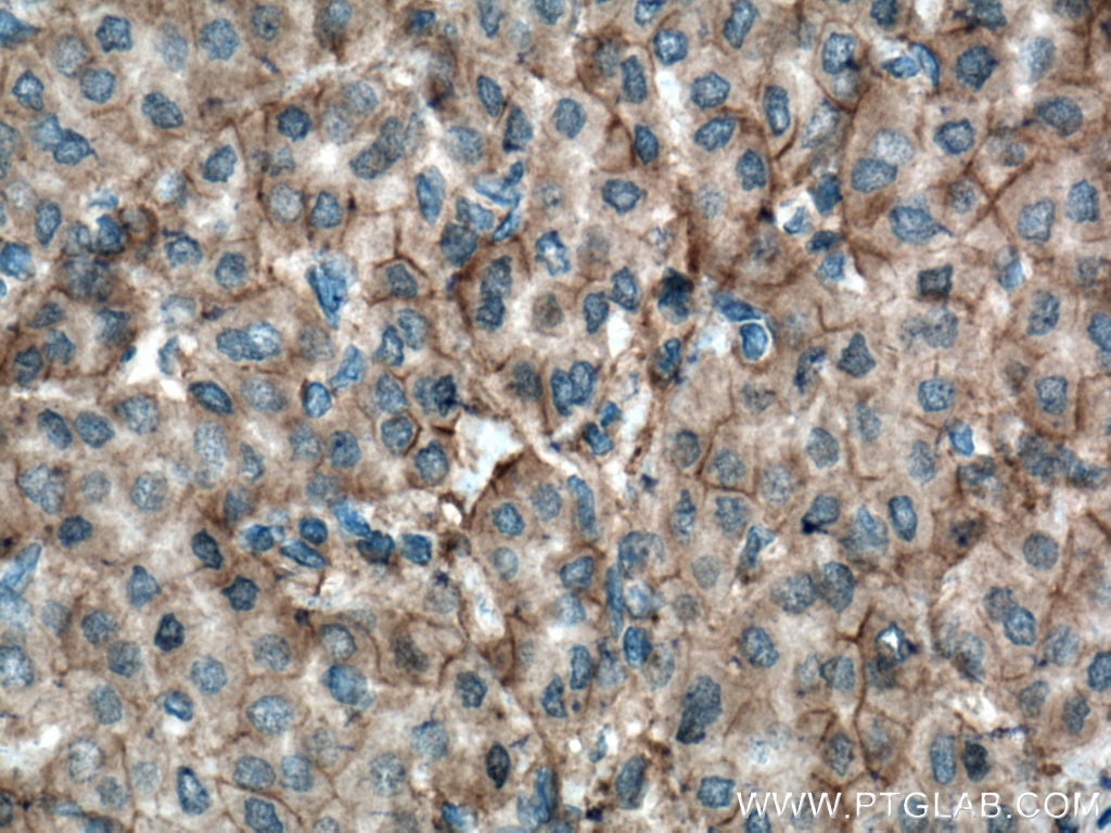 Immunohistochemistry (IHC) staining of human liver cancer tissue using Plexin B2 Polyclonal antibody (10602-1-AP)