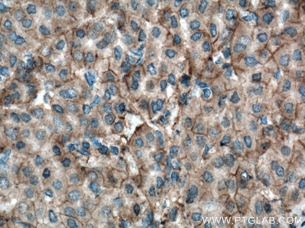 Immunohistochemistry (IHC) staining of human liver cancer tissue using Plexin B2 Polyclonal antibody (10602-1-AP)