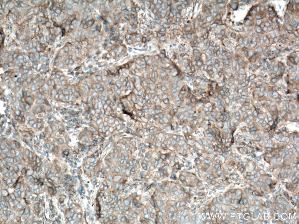 Immunohistochemistry (IHC) staining of human breast cancer tissue using Plexin B2 Polyclonal antibody (10602-1-AP)