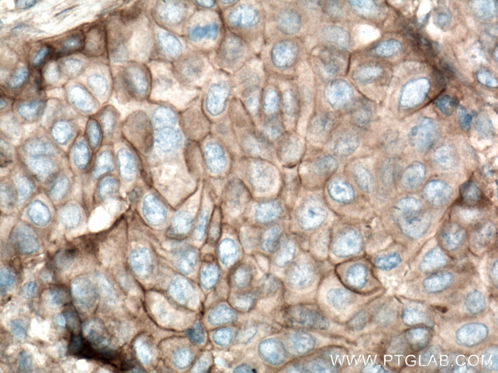 Immunohistochemistry (IHC) staining of human breast cancer tissue using Plexin B2 Polyclonal antibody (10602-1-AP)
