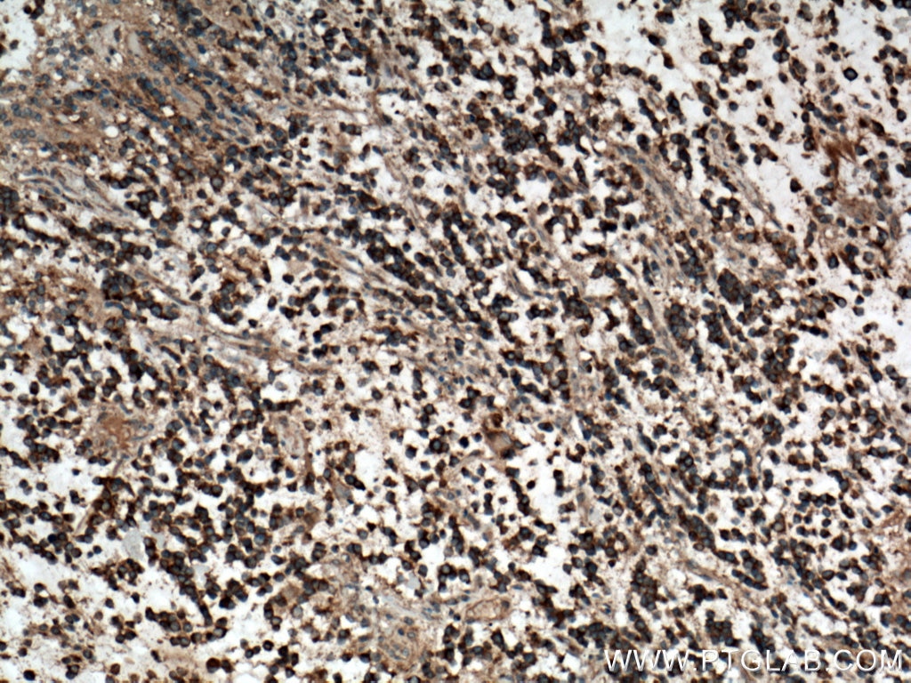 Immunohistochemistry (IHC) staining of human gliomas tissue using Plexin B2 Polyclonal antibody (10602-1-AP)