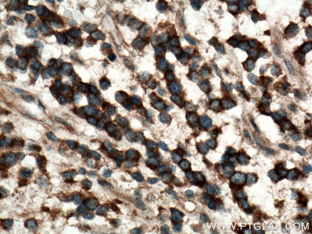 Immunohistochemistry (IHC) staining of human gliomas tissue using Plexin B2 Polyclonal antibody (10602-1-AP)