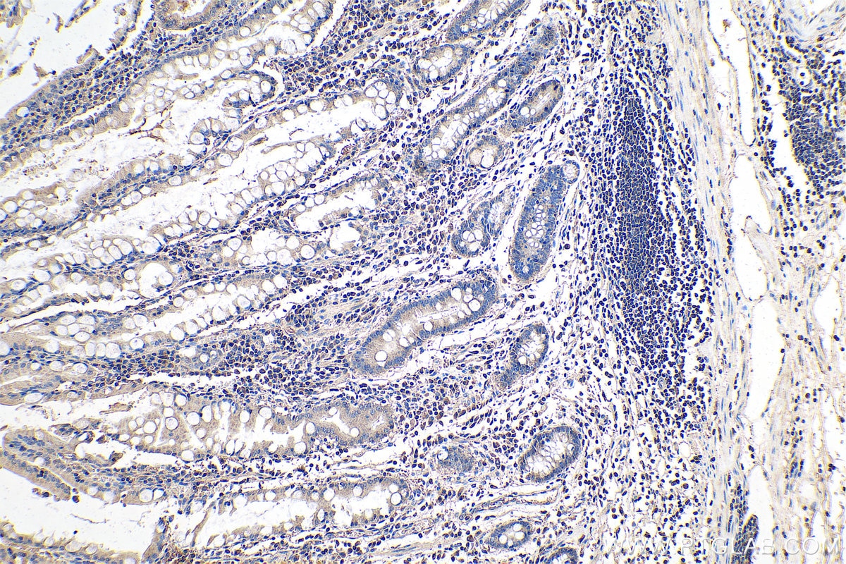 Immunohistochemistry (IHC) staining of human stomach cancer tissue using PMEPA1 Polyclonal antibody (16521-1-AP)