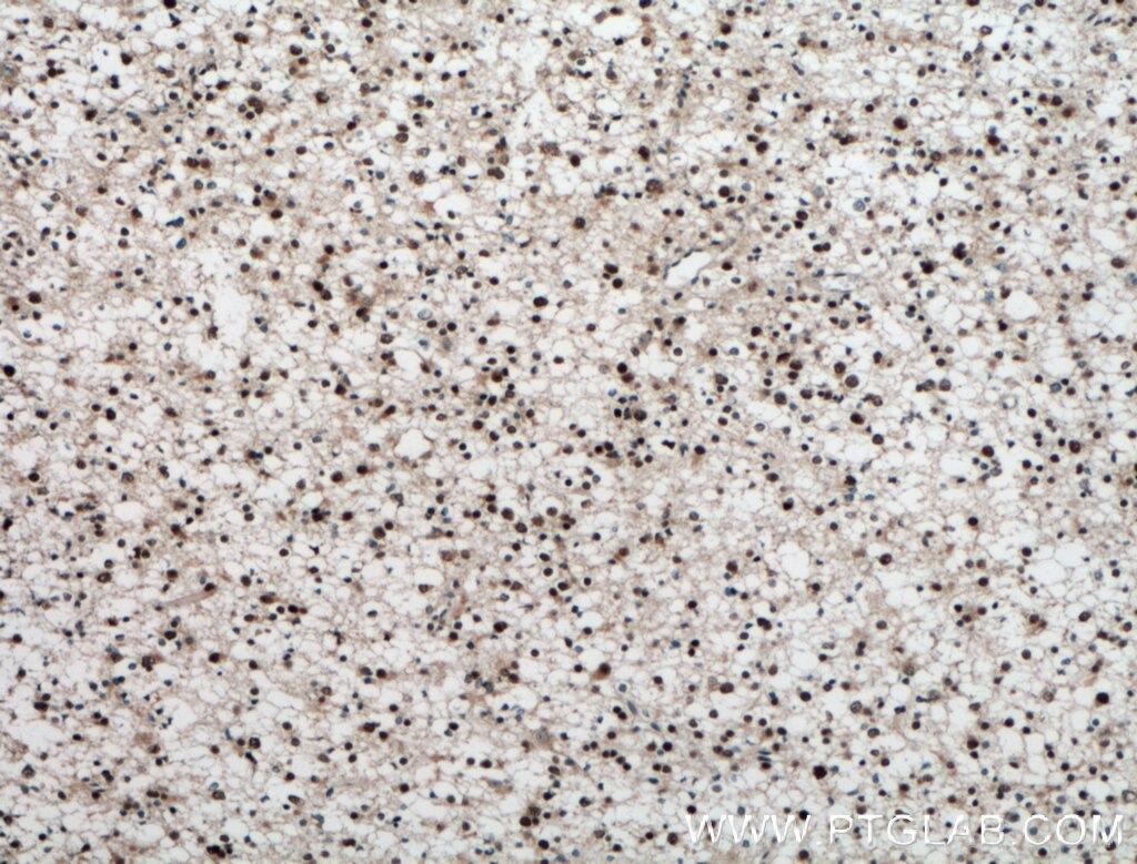 Immunohistochemistry (IHC) staining of human gliomas tissue using PMF1 Polyclonal antibody (11190-2-AP)