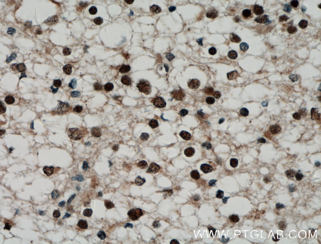 PMF1 Antibody IHC human gliomas tissue 11190-2-AP