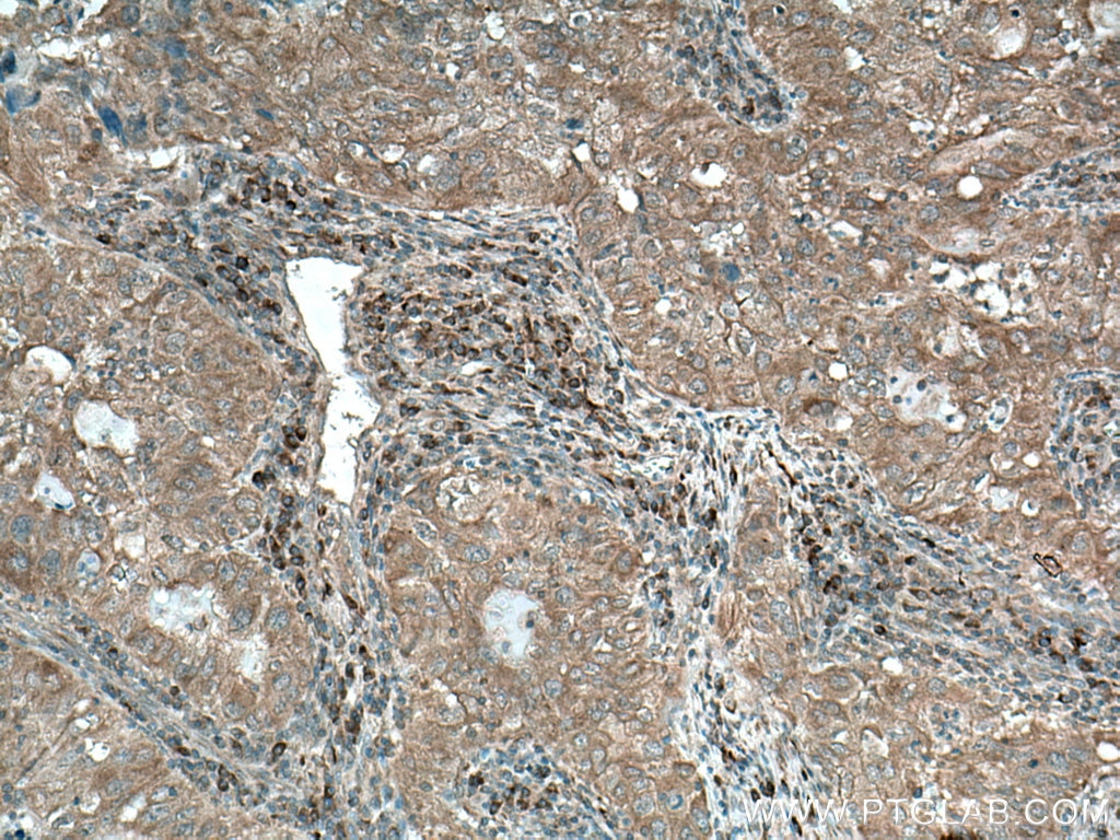 Immunohistochemistry (IHC) staining of human lung cancer tissue using PMM1 Polyclonal antibody (11252-2-AP)