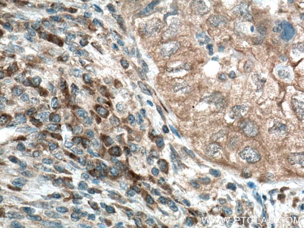 Immunohistochemistry (IHC) staining of human lung cancer tissue using PMM1 Polyclonal antibody (11252-2-AP)