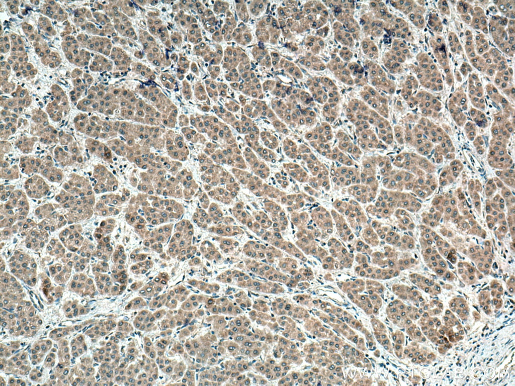 Immunohistochemistry (IHC) staining of human liver cancer tissue using PMM1 Polyclonal antibody (11252-2-AP)