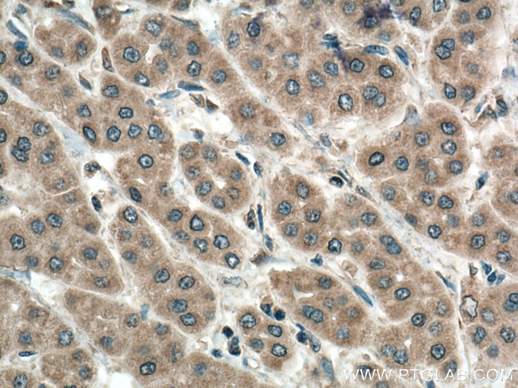 Immunohistochemistry (IHC) staining of human liver cancer tissue using PMM1 Polyclonal antibody (11252-2-AP)