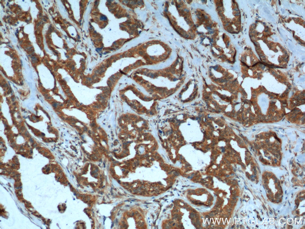 Immunohistochemistry (IHC) staining of human breast cancer tissue using PMM2 Polyclonal antibody (10666-1-AP)