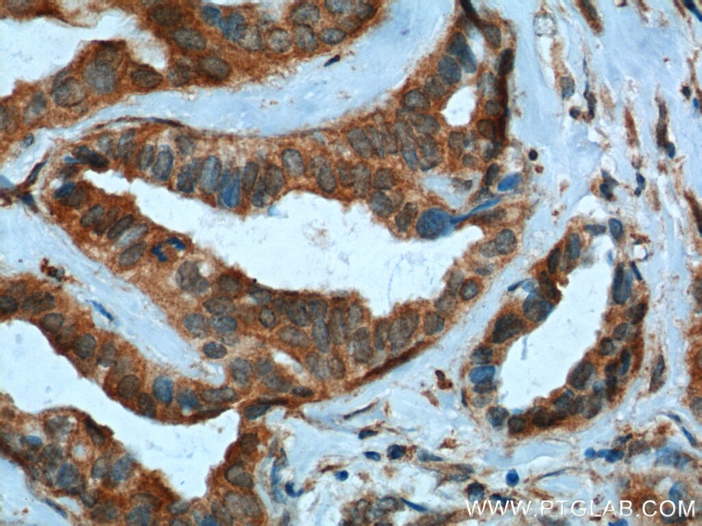 Immunohistochemistry (IHC) staining of human breast cancer tissue using PMM2 Polyclonal antibody (10666-1-AP)