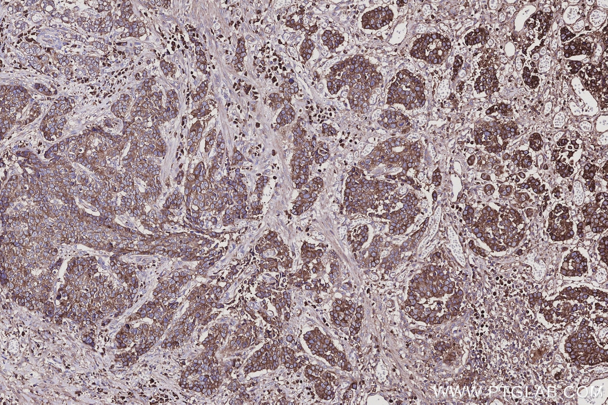 Immunohistochemistry (IHC) staining of human stomach cancer tissue using PMM2 Polyclonal antibody (10666-1-AP)