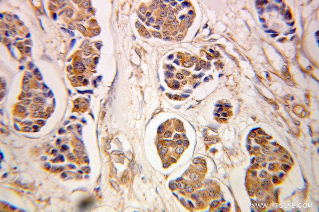Immunohistochemistry (IHC) staining of human breast cancer tissue using PMM2 Polyclonal antibody (10666-1-AP)