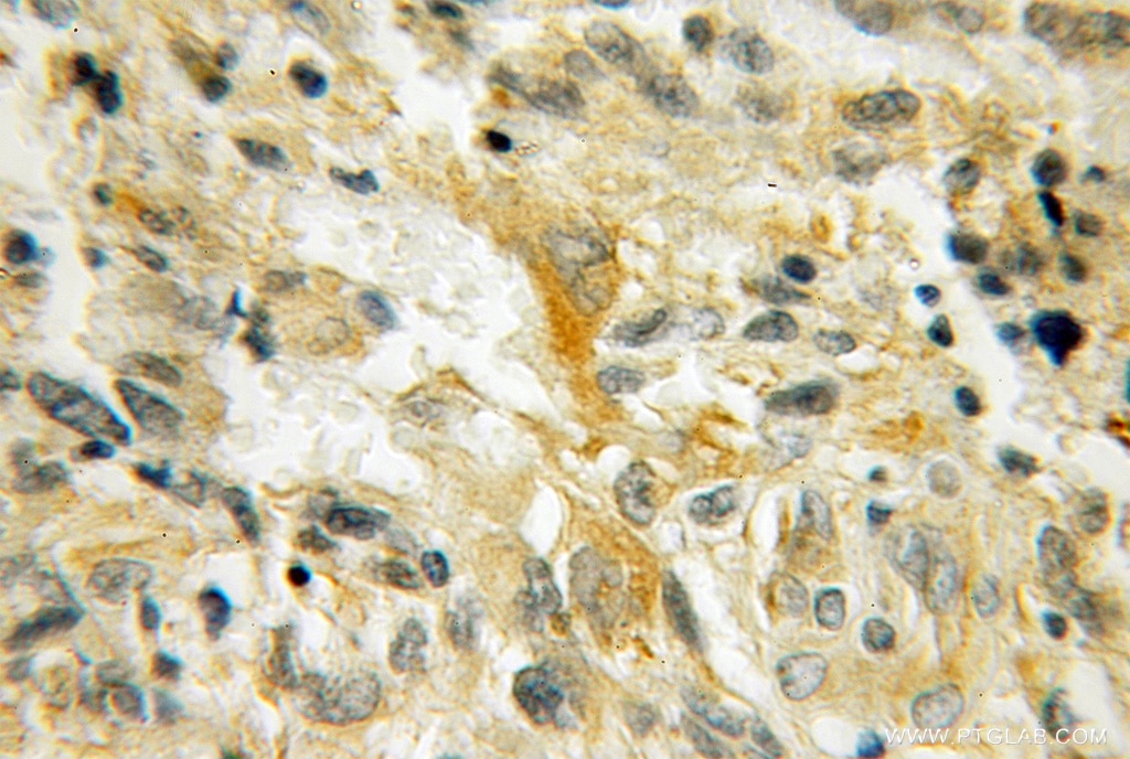 Immunohistochemistry (IHC) staining of human gliomas tissue using PMP2 Polyclonal antibody (12717-1-AP)