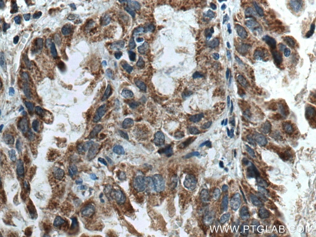 Immunohistochemistry (IHC) staining of human lung cancer tissue using PMPCB Polyclonal antibody (16064-1-AP)
