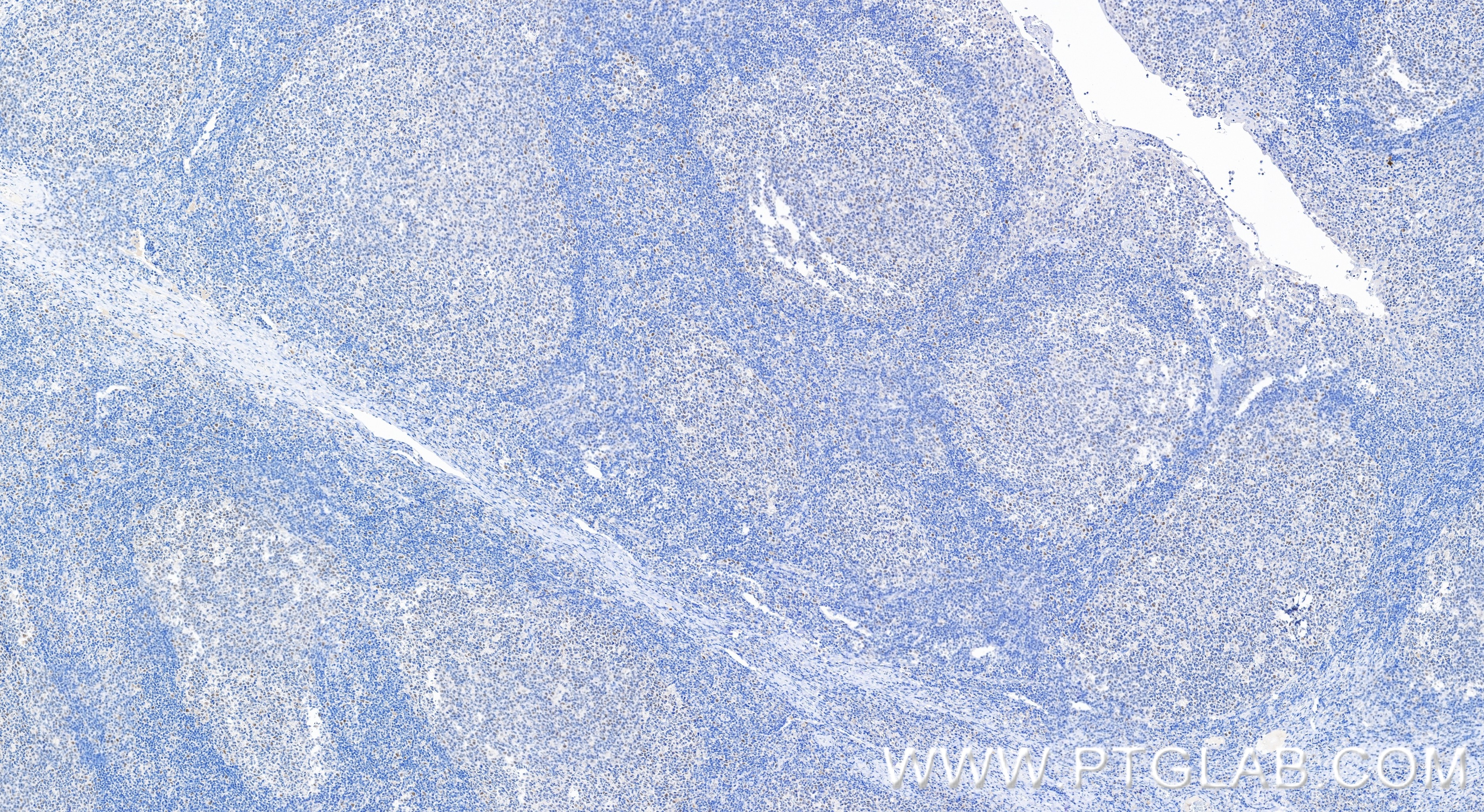 Immunohistochemistry (IHC) staining of human tonsillitis tissue using PMS1 Recombinant monoclonal antibody (83456-6-RR)