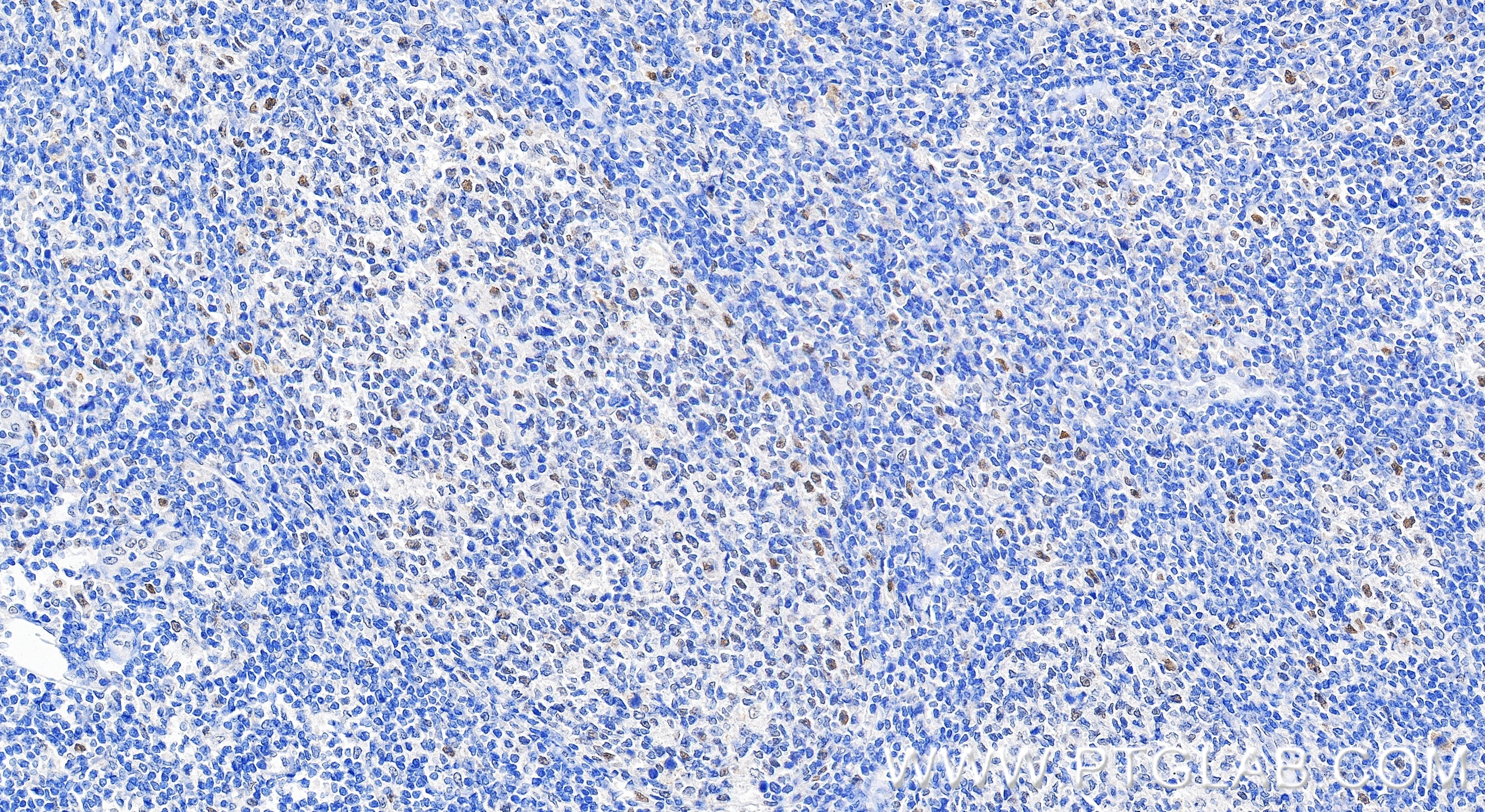 Immunohistochemistry (IHC) staining of human tonsillitis tissue using PMS1 Recombinant monoclonal antibody (83456-6-RR)