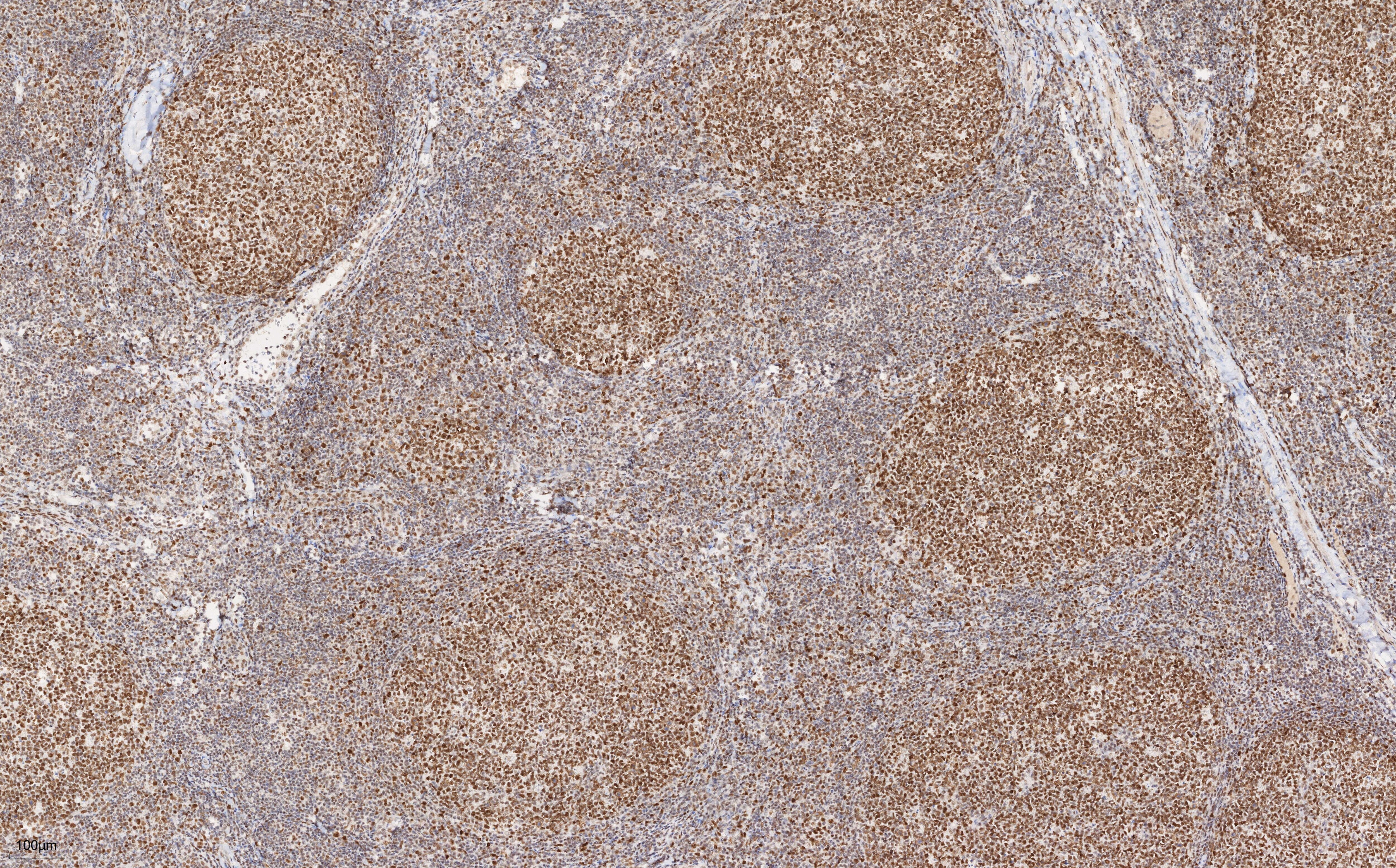 Immunohistochemistry (IHC) staining of human tonsillitis tissue using PMS2 Monoclonal antibody (68905-5-Ig)